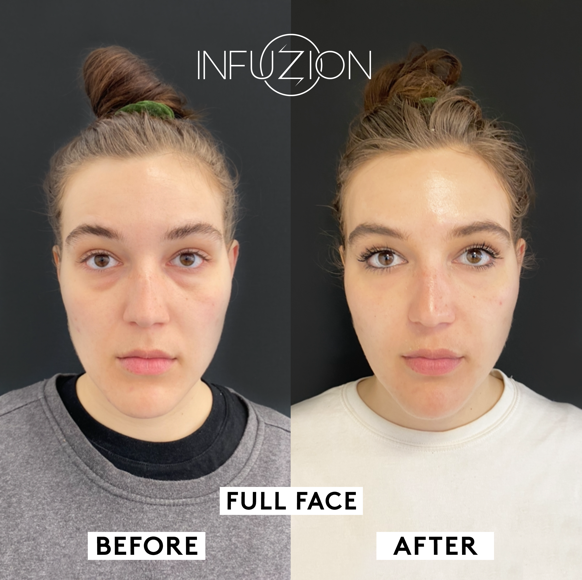 Infuzion Volymizer före och efter – Eya