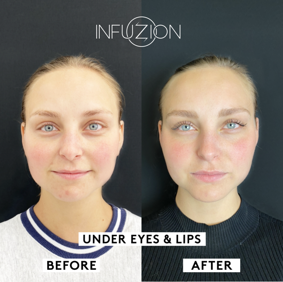 Infuzion Volymizer före och efter – Madeleine